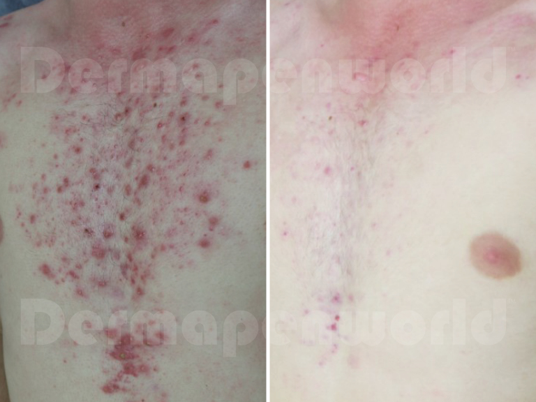 Before-&-After-Landing-Page-Acne